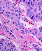 Ormus Minerals Chaga Mushrooms - cancer cells Ormus Minerals Chaga Mushrooms - cancer cells